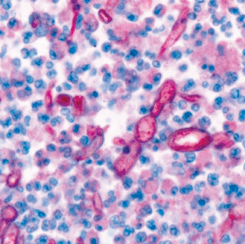 Image: Fungal hyphae (red) in brain of a fatal case as seen using polyfungal immunohistochemistry (Photo courtesy of the American Journal of Pathology).